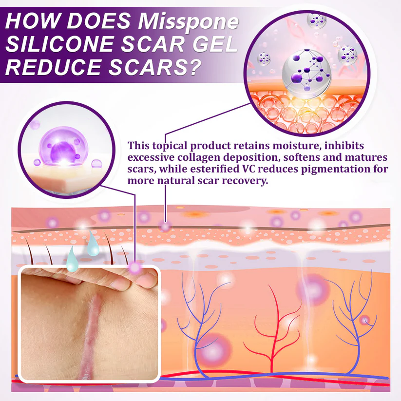 💙 UKCA-Certified ✅Misspone® Scar Gel – Clinically Proven to Fade Surgical, Acne, Burn & Trauma Scars